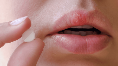 Herpes môi (mụn rộp môi) có nguy hiểm không? Cách điều trị herpes môi • Hello Bacsi